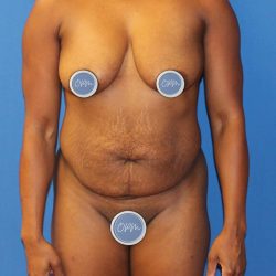 Tummy Tuck Before & After Patient #1844
