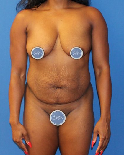 Tummy Tuck Before & After Patient #1844