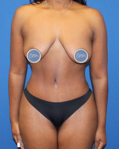 Tummy Tuck Before & After Patient #1852