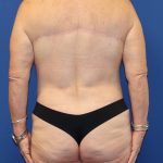 Back Lift Before & After Patient #1855