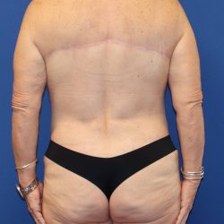 Back Lift Before & After Patient #1855