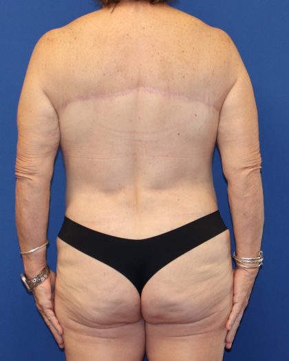 Back Lift Before & After Patient #1855
