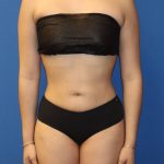Liposuction 360 Before & After Patient #1865