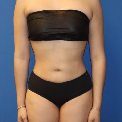 Liposuction 360 Before & After Patient #1865