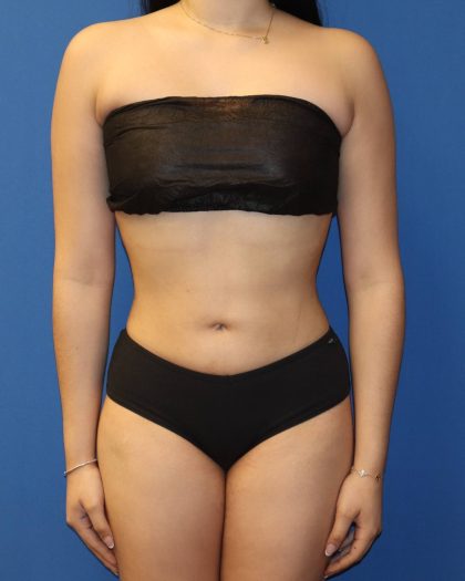 Liposuction 360 Before & After Patient #1865