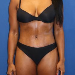 Tummy Tuck Before & After Patient #1844