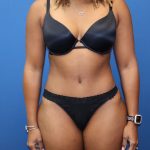 Tummy Tuck Before & After Patient #1845