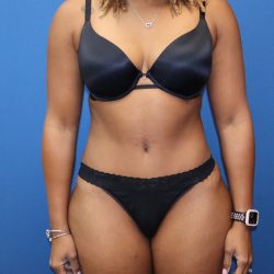 Tummy Tuck Before & After Patient #1845