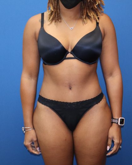 Tummy Tuck Before & After Patient #1845