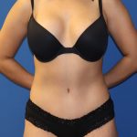 Tummy Tuck Before & After Patient #1848