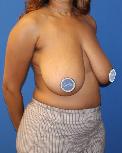 Breast Reduction Before & After Patient #1862