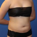 Liposuction 360 Before & After Patient #1865
