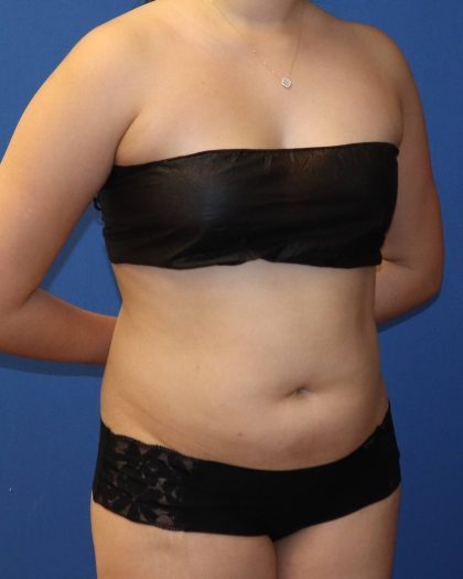 Liposuction 360 Before & After Patient #1865