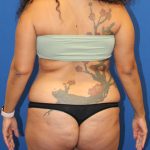 Tummy Tuck Before & After Patient #1842