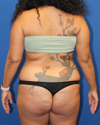 Tummy Tuck Before & After Patient #1842