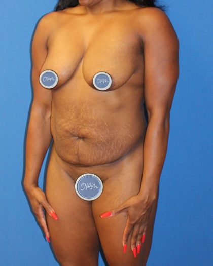 Tummy Tuck Before & After Patient #1844