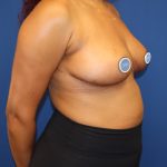 Breast Reduction Before & After Patient #1862