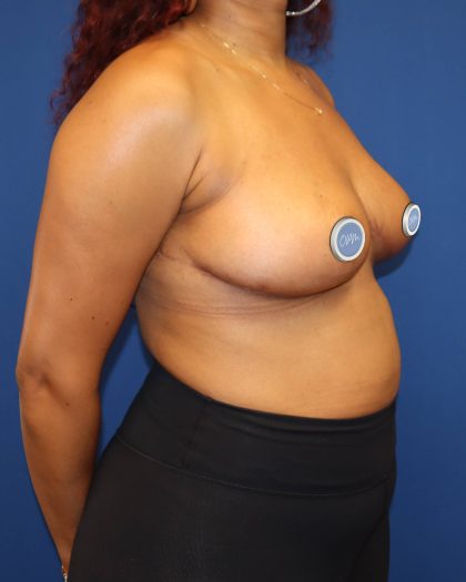 Breast Reduction Before & After Patient #1862
