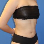 Liposuction 360 Before & After Patient #1865