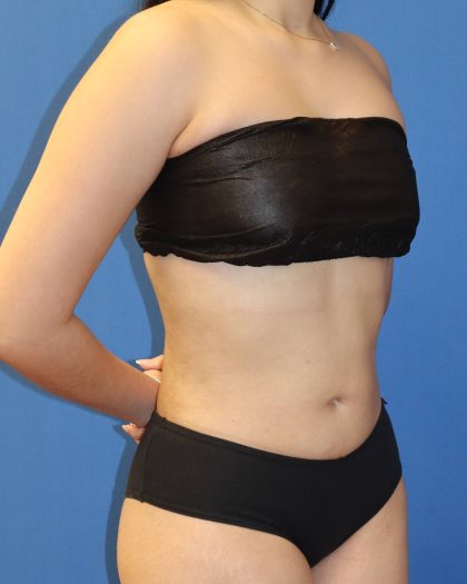 Liposuction 360 Before & After Patient #1865