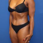 Tummy Tuck Before & After Patient #1844