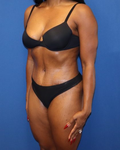 Tummy Tuck Before & After Patient #1844