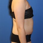 Liposuction 360 Before & After Patient #1865