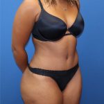 Tummy Tuck Before & After Patient #1845