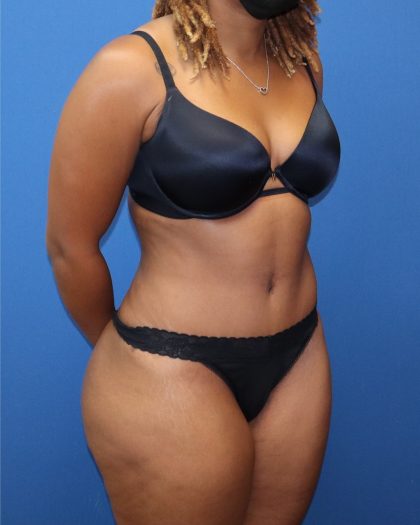 Tummy Tuck Before & After Patient #1845