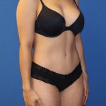 Tummy Tuck Before & After Patient #1848