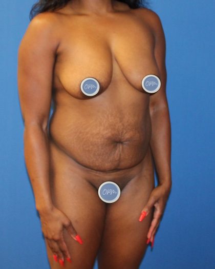 Tummy Tuck Before & After Patient #1844