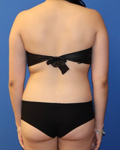Liposuction 360 Before & After Patient #1865