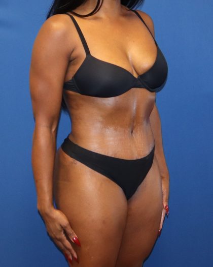 Tummy Tuck Before & After Patient #1844