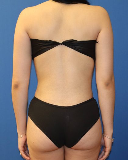 Liposuction 360 Before & After Patient #1865