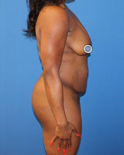 Tummy Tuck Before & After Patient #1844